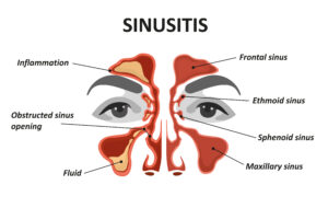 sinusitis inflammation